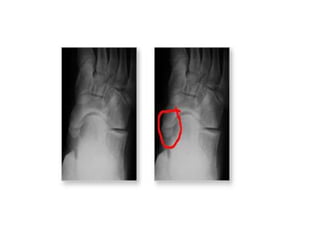 Accessory navicular