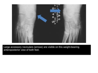 Large accessory naviculars (arrows) are visible on this weight-bearing
anteroposterior view of both feet.

 