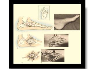 Accessory navicular