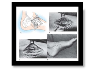 Accessory navicular