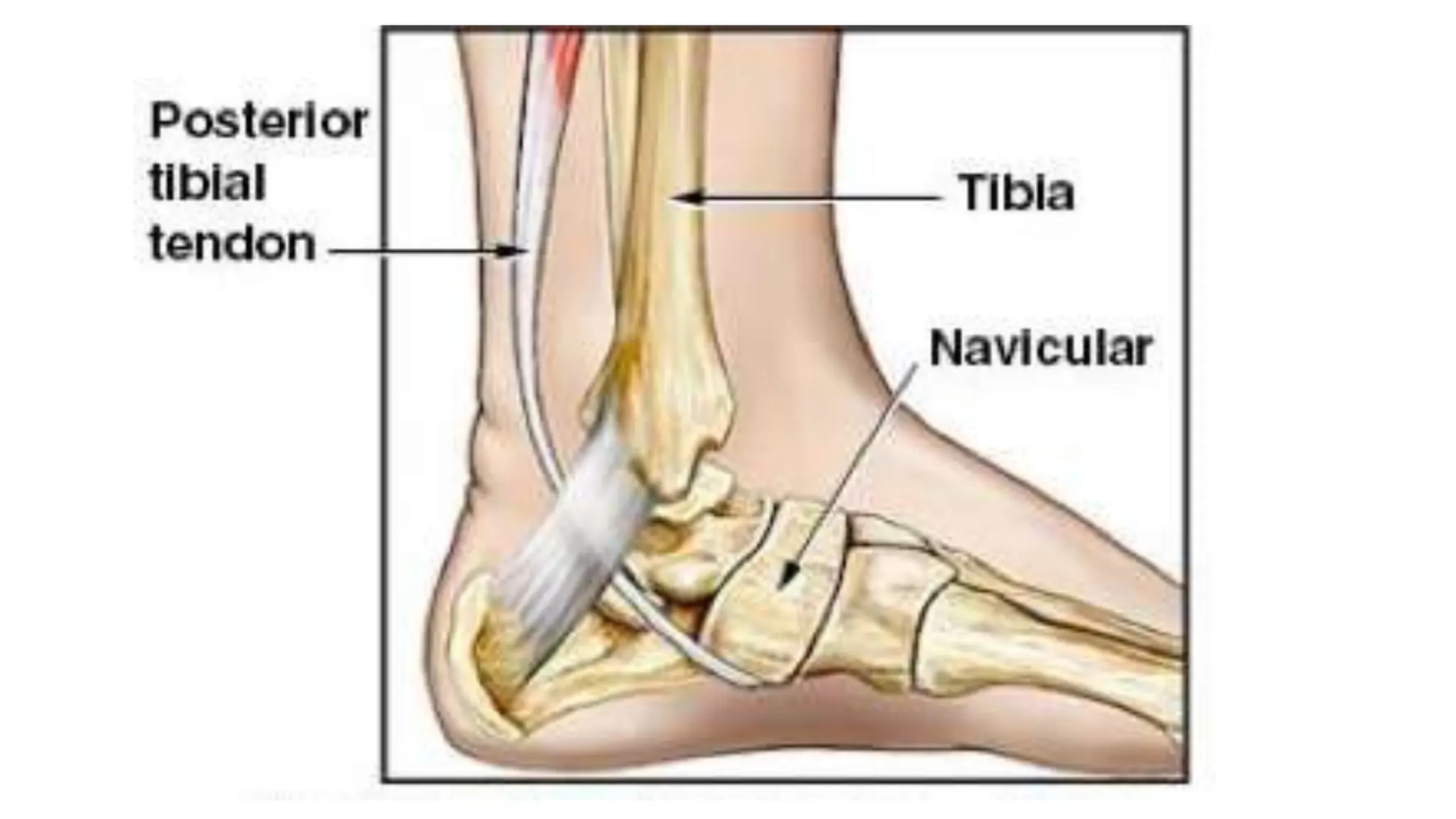 Accessory Navicular Bone.pptx