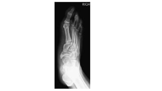 Accessory Navicular Bone.pptx