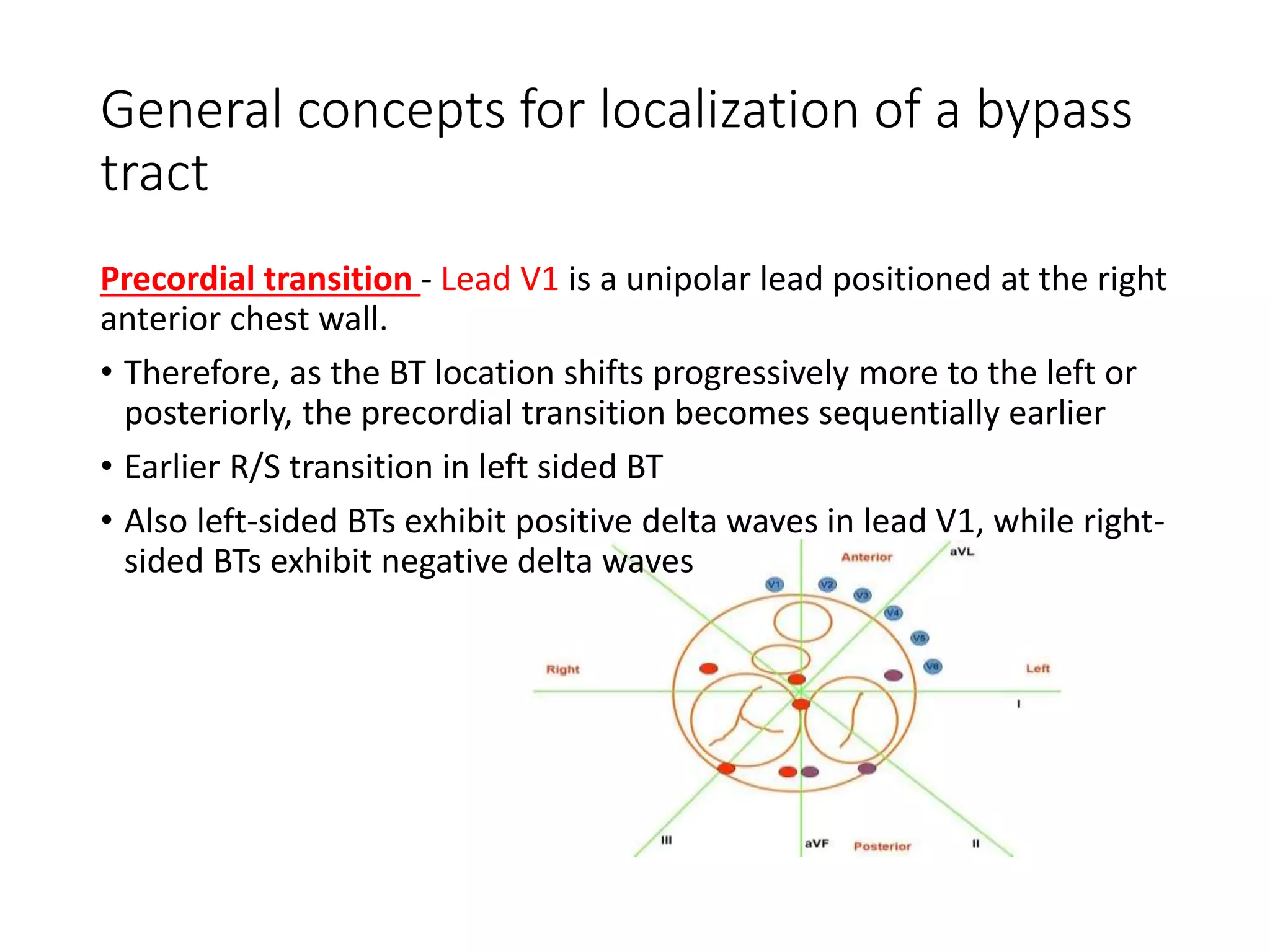 General concepts for localization of a bypass
tract
Precordial transition - Lead V1 is a unipolar lead positioned at the right
anterior chest wall.
• Therefore, as the BT location shifts progressively more to the left or
posteriorly, the precordial transition becomes sequentially earlier
• Earlier R/S transition in left sided BT
• Also left-sided BTs exhibit positive delta waves in lead V1, while right-
sided BTs exhibit negative delta waves
 