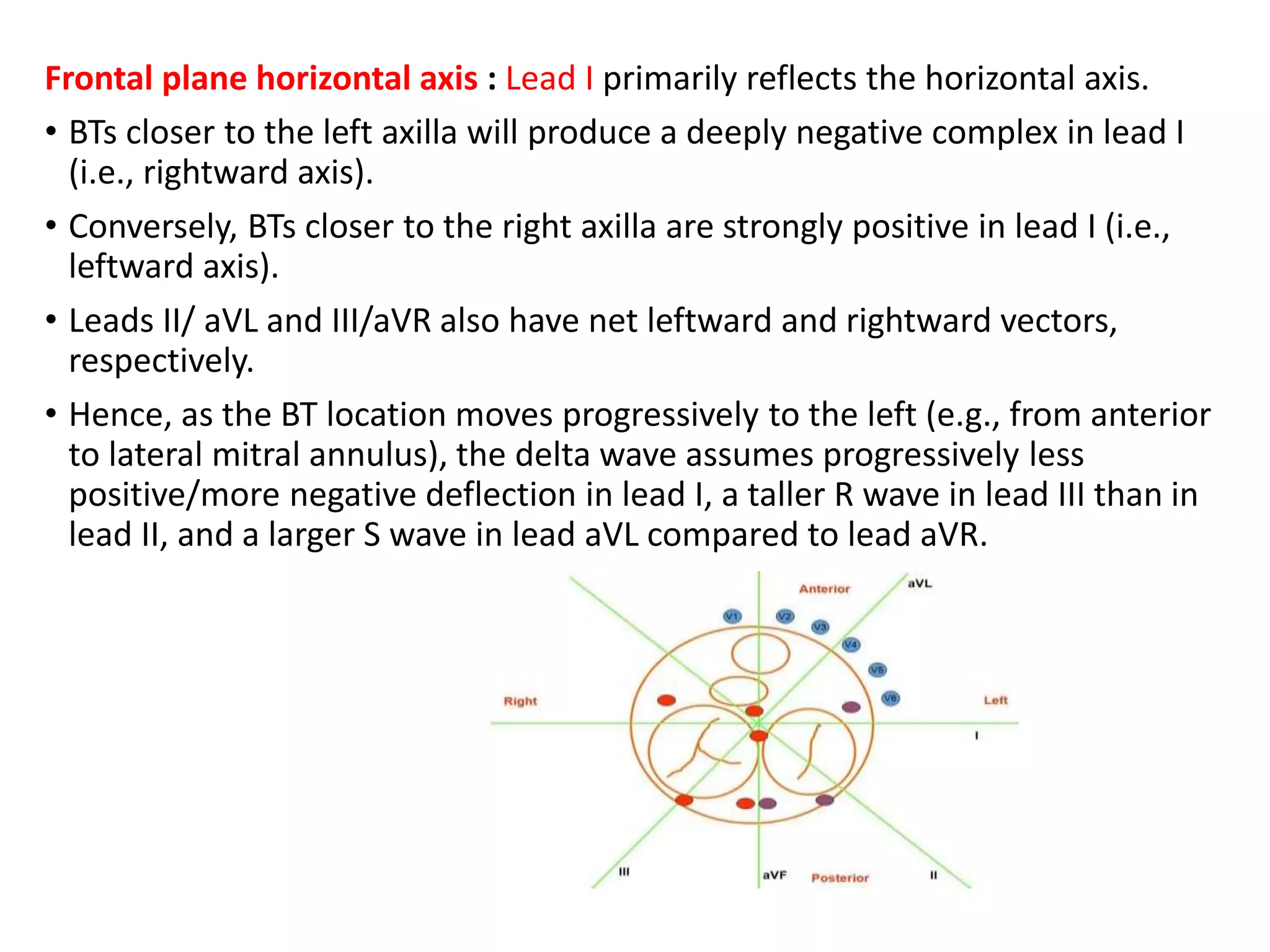 Frontal plane horizontal axis : Lead I primarily reflects the horizontal axis.
• BTs closer to the left axilla will produce a deeply negative complex in lead I
(i.e., rightward axis).
• Conversely, BTs closer to the right axilla are strongly positive in lead I (i.e.,
leftward axis).
• Leads II/ aVL and III/aVR also have net leftward and rightward vectors,
respectively.
• Hence, as the BT location moves progressively to the left (e.g., from anterior
to lateral mitral annulus), the delta wave assumes progressively less
positive/more negative deflection in lead I, a taller R wave in lead III than in
lead II, and a larger S wave in lead aVL compared to lead aVR.
 