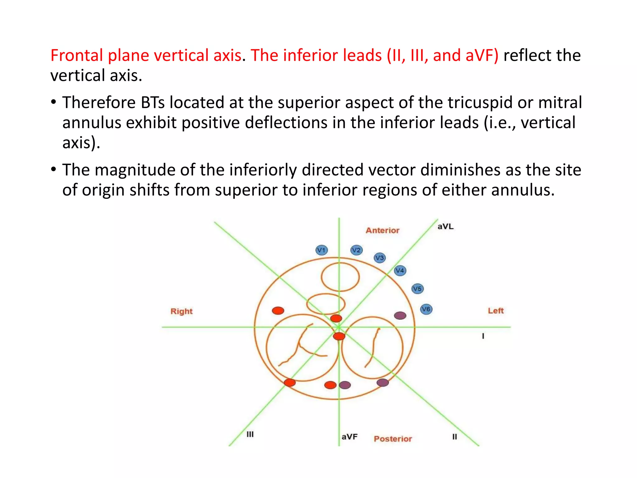 Frontal plane vertical axis. The inferior leads (II, III, and aVF) reflect the
vertical axis.
• Therefore BTs located at the superior aspect of the tricuspid or mitral
annulus exhibit positive deflections in the inferior leads (i.e., vertical
axis).
• The magnitude of the inferiorly directed vector diminishes as the site
of origin shifts from superior to inferior regions of either annulus.
 