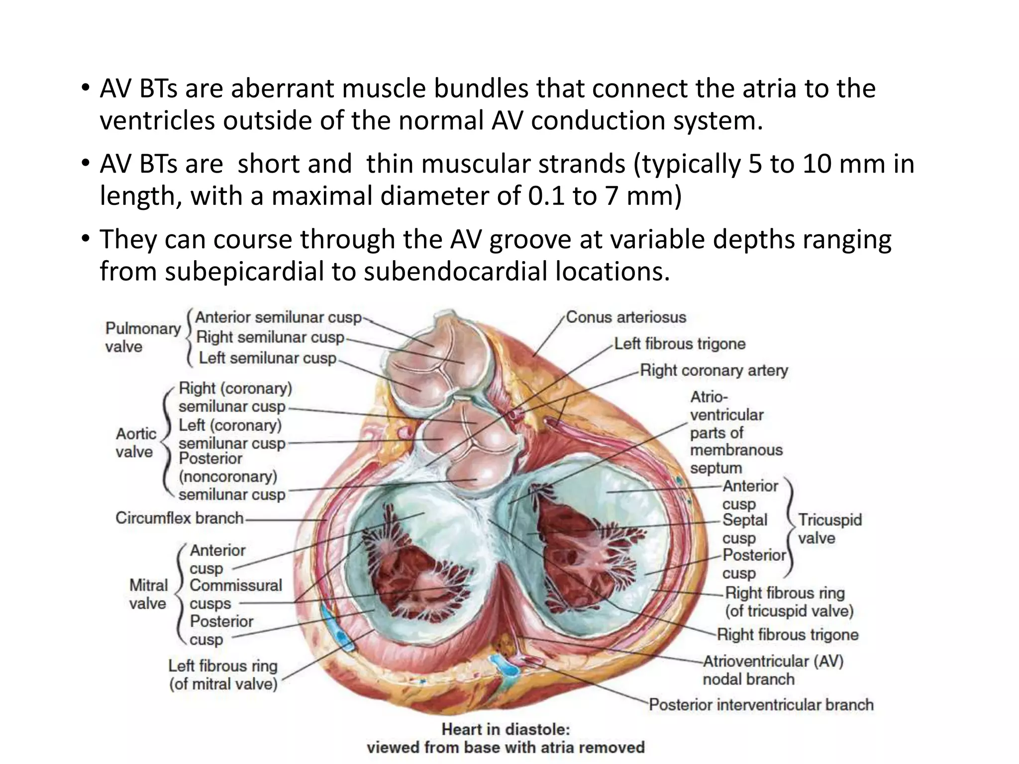 • AV BTs are aberrant muscle bundles that connect the atria to the
ventricles outside of the normal AV conduction system.
• AV BTs are short and thin muscular strands (typically 5 to 10 mm in
length, with a maximal diameter of 0.1 to 7 mm)
• They can course through the AV groove at variable depths ranging
from subepicardial to subendocardial locations.
 