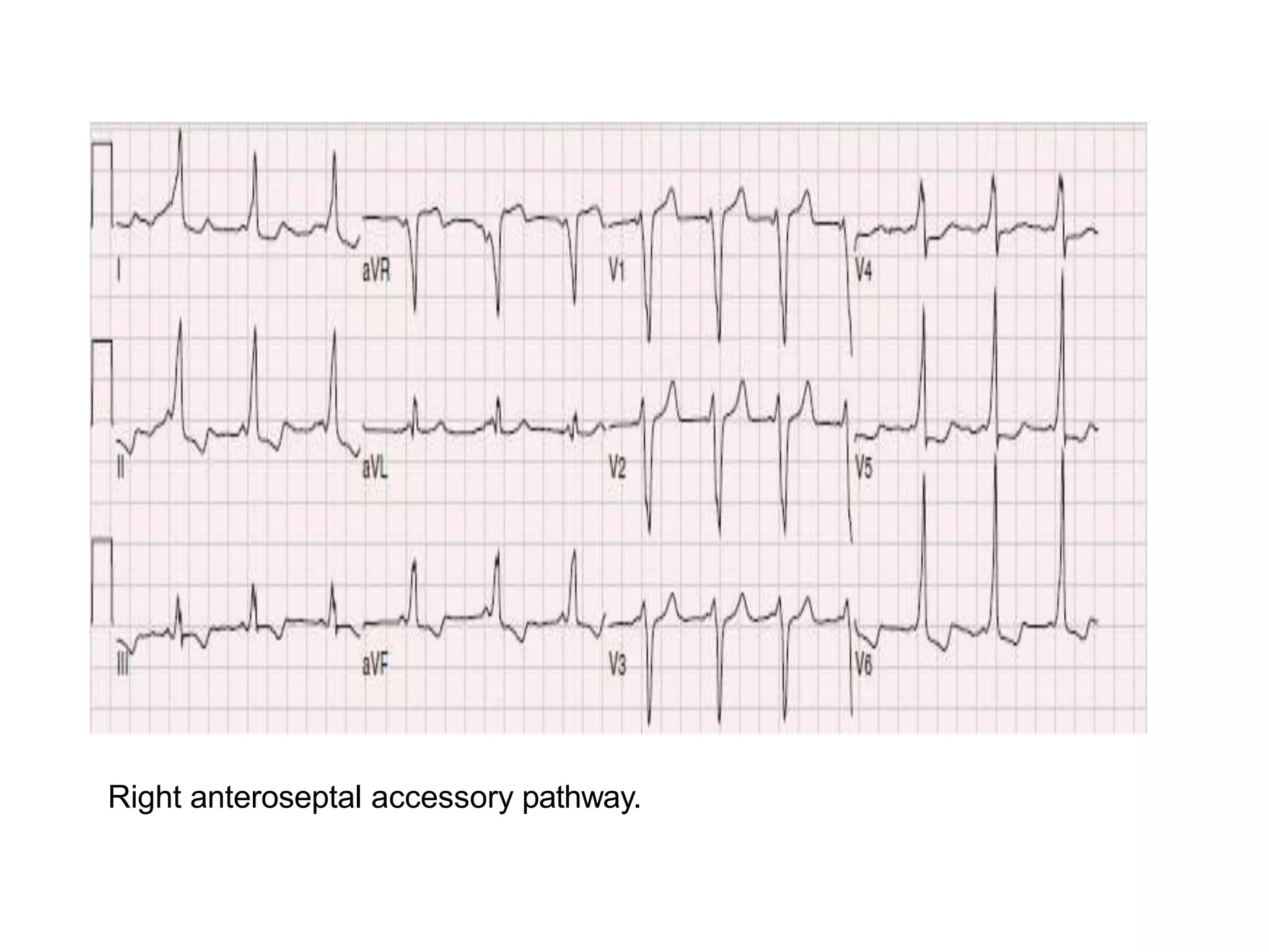 Right anteroseptal accessory pathway.
 
