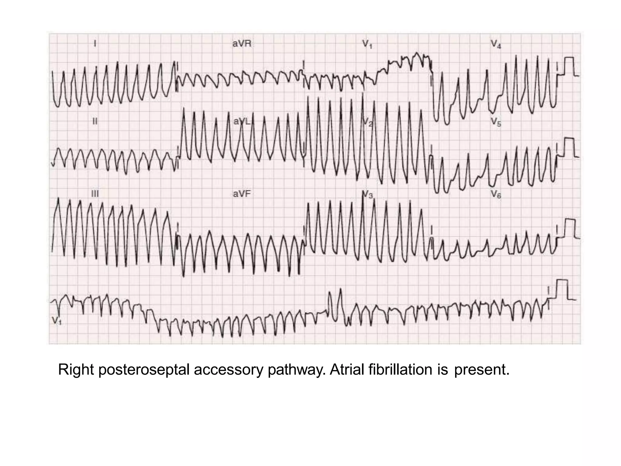 Right posteroseptal accessory pathway. Atrial fibrillation is present.
 