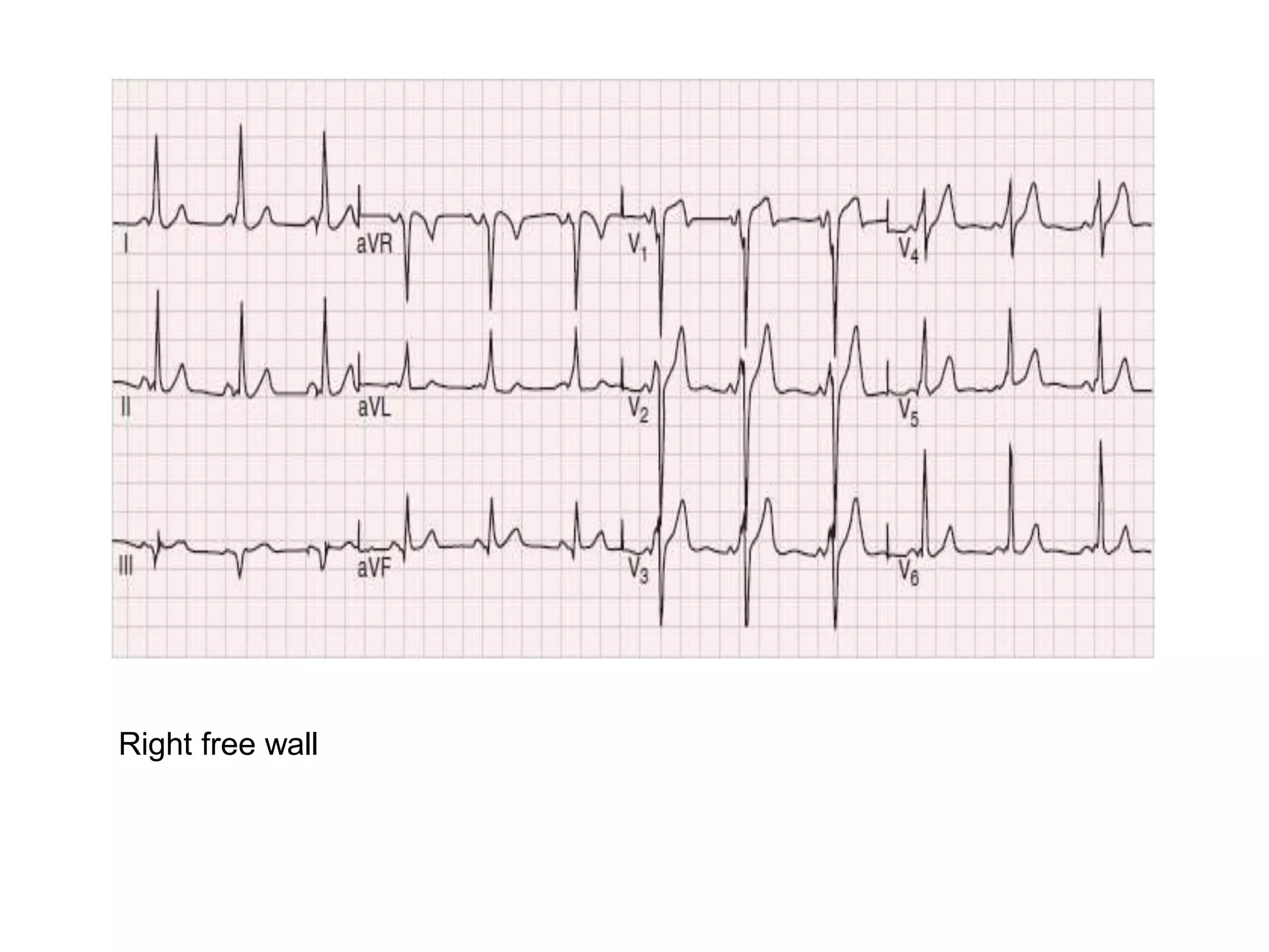 Right free wall
 