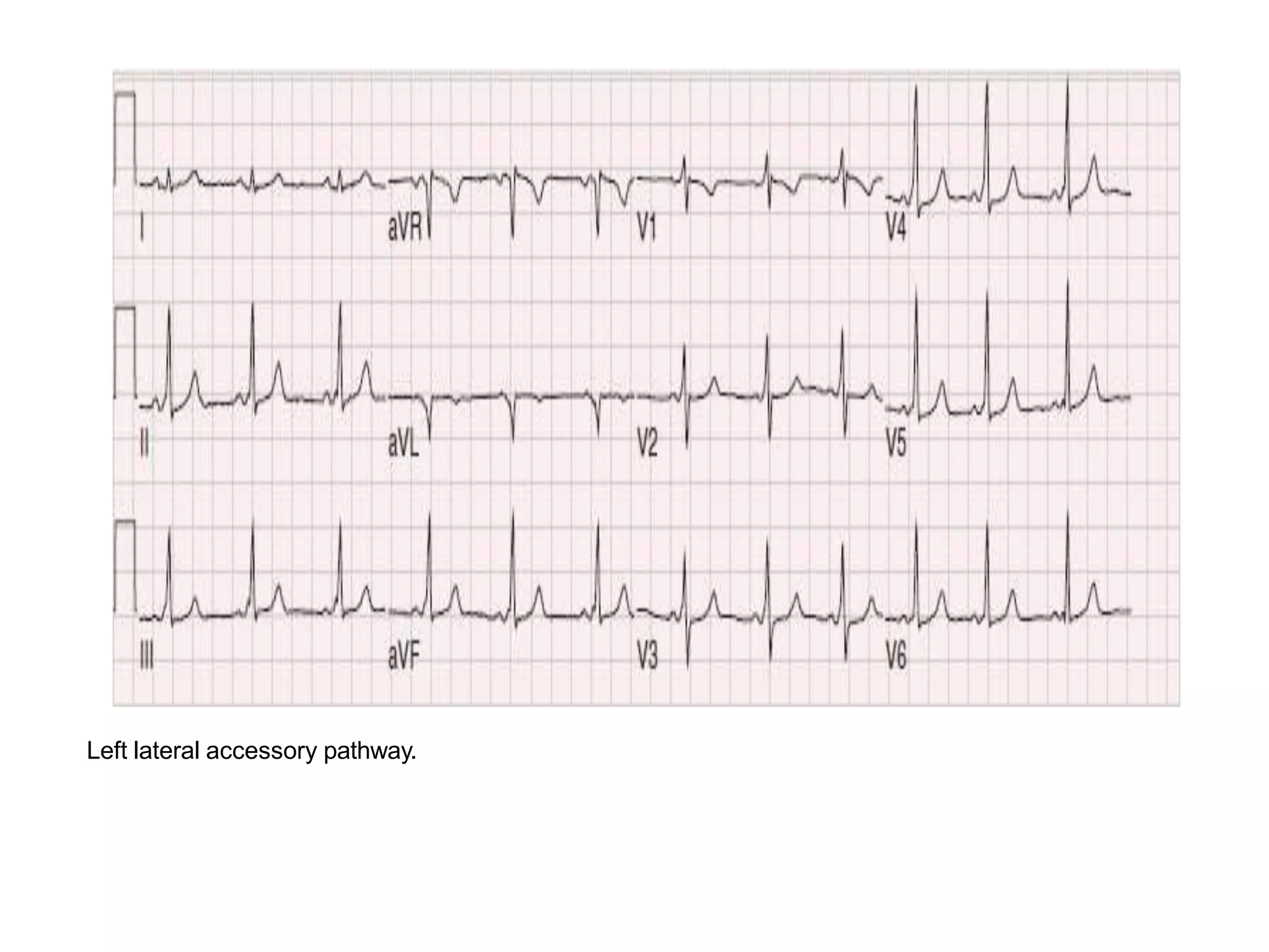 Left lateral accessory pathway.
 