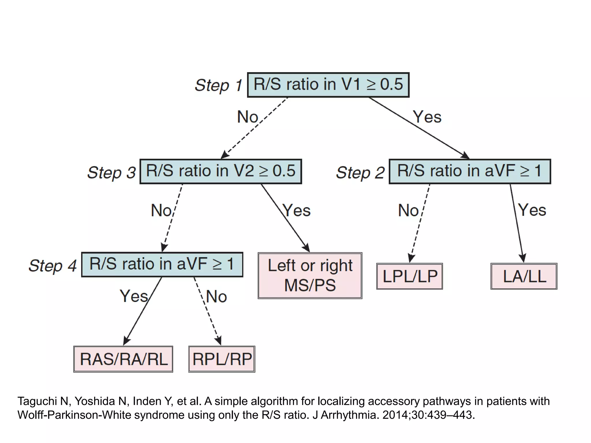 Taguchi N, Yoshida N, Inden Y, et al. A simple algorithm for localizing accessory pathways in patients with
Wolff-Parkinson-White syndrome using only the R/S ratio. J Arrhythmia. 2014;30:439–443.
 