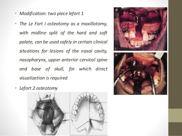lefort osteotomies
