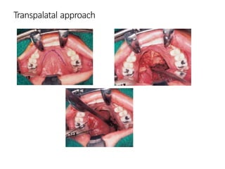 Access osteotomies in oral & cranio-maxillofacial surgery | PPTX