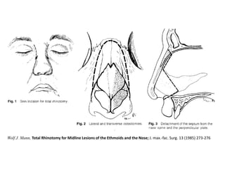 Total Rhinotomy Access osteotomies in oral & cranio-maxillofacial surgery | PPTX