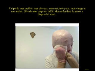 J ’ ai perdu mes oreilles, mes cheveux, mon nez, mes yeux, mon visage et mes mains. 60% de mon corps est brûlé. Mon reflet dans le miroir a disparu lui aussi.  >>> 