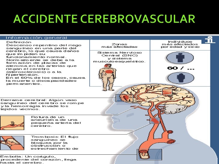 Accidente cerebrovascular Accidente cerebrovascular