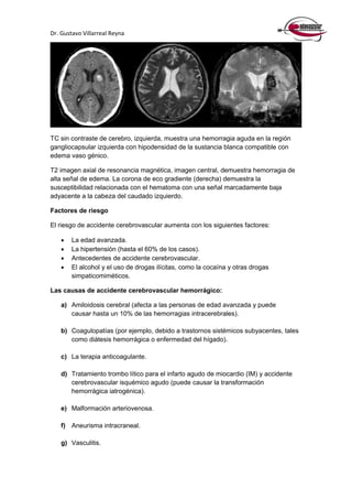 Dr. Gustavo Villarreal Reyna
TC sin contraste de cerebro, izquierda, muestra una hemorragia aguda en la región
gangliocapsular izquierda con hipodensidad de la sustancia blanca compatible con
edema vaso génico.
T2 imagen axial de resonancia magnética, imagen central, demuestra hemorragia de
alta señal de edema. La corona de eco gradiente (derecha) demuestra la
susceptibilidad relacionada con el hematoma con una señal marcadamente baja
adyacente a la cabeza del caudado izquierdo.
Factores de riesgo
El riesgo de accidente cerebrovascular aumenta con los siguientes factores:
 La edad avanzada.
 La hipertensión (hasta el 60% de los casos).
 Antecedentes de accidente cerebrovascular.
 El alcohol y el uso de drogas ilícitas, como la cocaína y otras drogas
simpaticomiméticos.
Las causas de accidente cerebrovascular hemorrágico:
a) Amiloidosis cerebral (afecta a las personas de edad avanzada y puede
causar hasta un 10% de las hemorragias intracerebrales).
b) Coagulopatías (por ejemplo, debido a trastornos sistémicos subyacentes, tales
como diátesis hemorrágica o enfermedad del hígado).
c) La terapia anticoagulante.
d) Tratamiento trombo lítico para el infarto agudo de miocardio (IM) y accidente
cerebrovascular isquémico agudo (puede causar la transformación
hemorrágica iatrogénica).
e) Malformación arteriovenosa.
f) Aneurisma intracraneal.
g) Vasculitis.
 