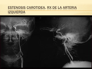 Accidente cerebro vascular