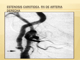 Accidente cerebro vascular