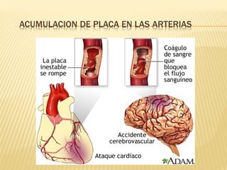 Accidente cerebro vascular