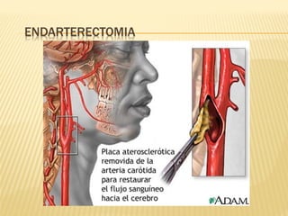 Accidente cerebro vascular