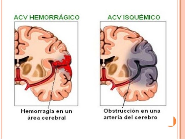 Accidente cerebrovascular