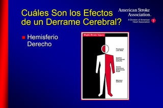 Cuáles Son los Efectos 
de un Derrame Cerebral? 
 Hemisferio 
Derecho 
 