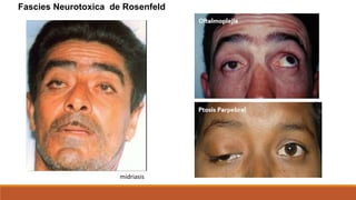 Fascies Neurotoxica de Rosenfeld
midriasis
 