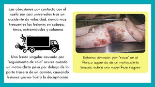 Las abrasiones por contacto con el
suelo son casi universales tras un
accidente de velocidad, siendo muy
frecuentes las lesiones en cabeza,
tórax, extremidades y columna
Extensa abrasión por "roce" en el
flanco izquierdo de un motociclista
lanzado sobre una superficie rugosa
Una lesión singular causada por
"seguimiento de cola" ocurre cuándo
un motociclista pasa por debajo de la
parte trasera de un camión, causando
lesiones graves hasta la decapitación
 