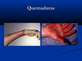 QuemadurasQuemaduras
 