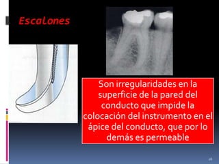 Escalones
Son irregularidades en la
superficie de la pared del
conducto que impide la
colocación del instrumento en el
ápice del conducto, que por lo
demás es permeable
26
 