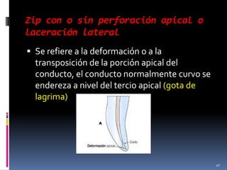 Zip con o sin perforación apical o
laceración lateral
 Se refiere a la deformación o a la
transposición de la porción apical del
conducto, el conducto normalmente curvo se
endereza a nivel del tercio apical (gota de
lagrima)
40
 