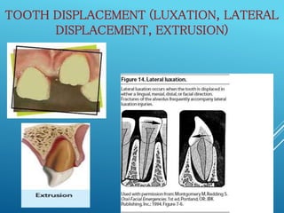 Accidents and injuries to primary and permanent anterior teeth | PPTX