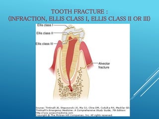 Infraction Tooth Accidents and injuries to primary and permanent anterior teeth | PPTX