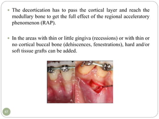 acclerated orthodontics.pptx