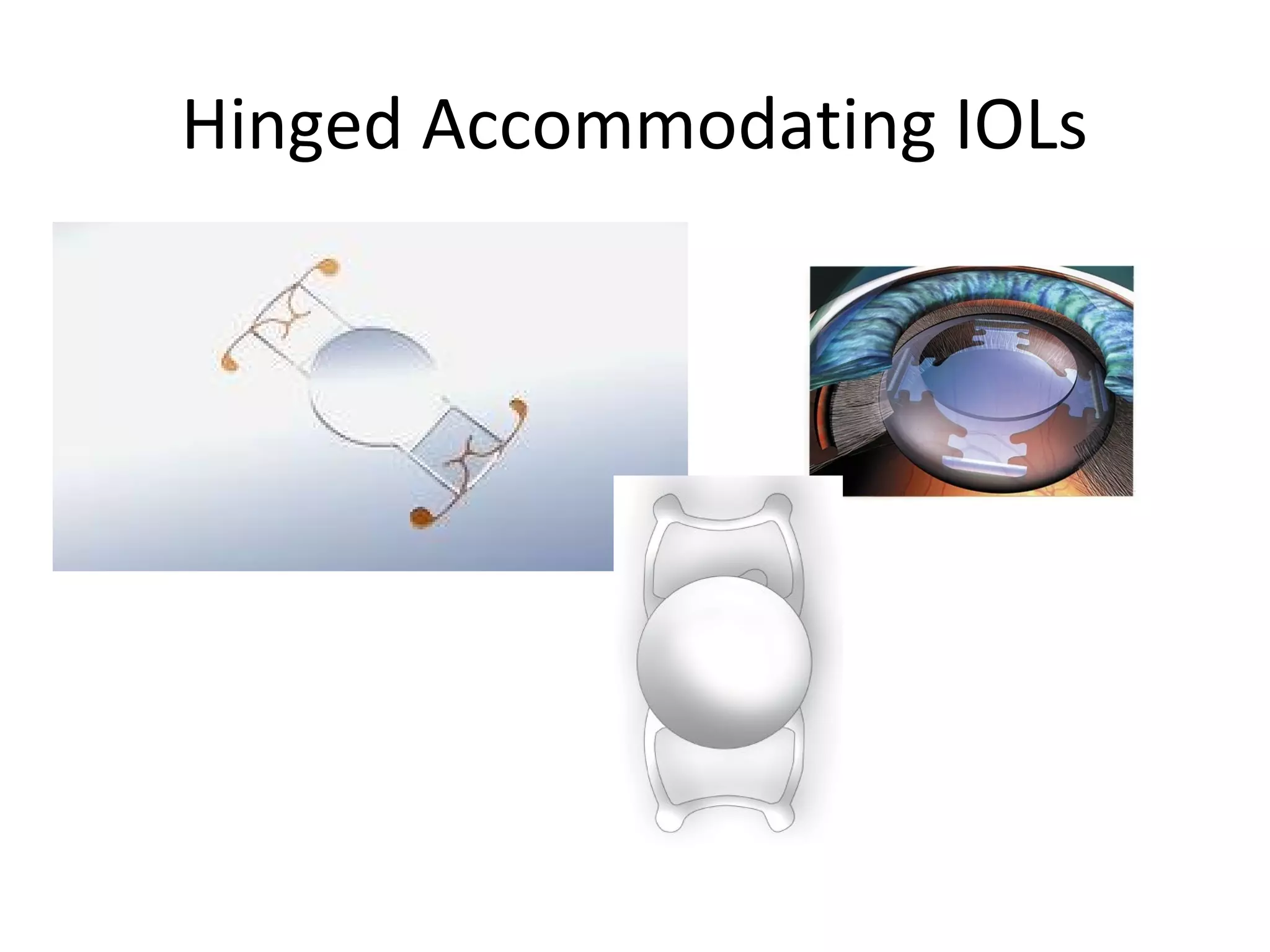 Hinged Accommodating IOLs
 