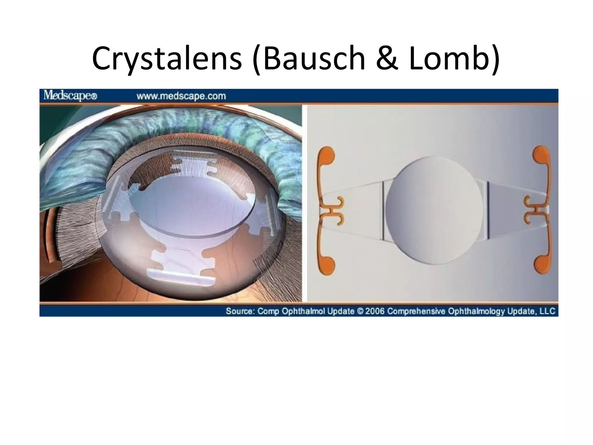 Crystalens (Bausch & Lomb)
 