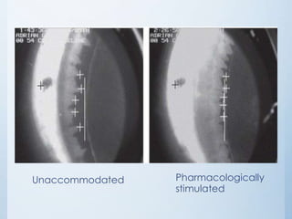 Unaccommodated

Pharmacologically
stimulated

 