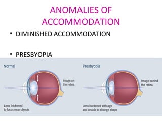 ANOMALIES OF
ACCOMMODATION
• DIMINISHED ACCOMMODATION
• PRESBYOPIA
 