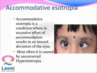 Accommodative esotropia
 Accommodative
esotropia is a
condition where in
excessive effort of
accommodation
results in an inward
deviation of the eyes.
 Most often it is caused
by uncorrected
Hypermetropia.
 