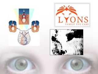 What is Accommodative Esotropia?