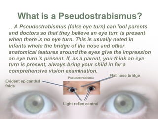 What is a Pseudostrabismus?
…A Pseudostrabismus (false eye turn) can fool parents
and doctors so that they believe an eye ...