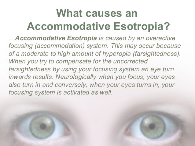 What Is Accommodative Esotropia
