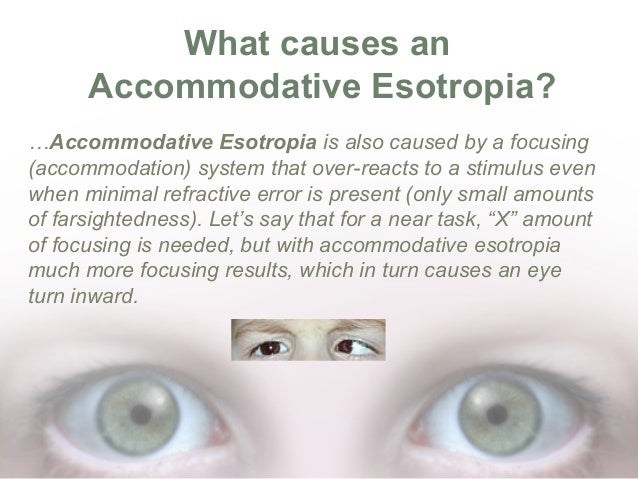 What Is Accommodative Esotropia