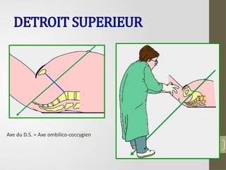 DETROIT SUPERIEUR
35
Axe du D.S. = Axe ombilico-coccygien
 