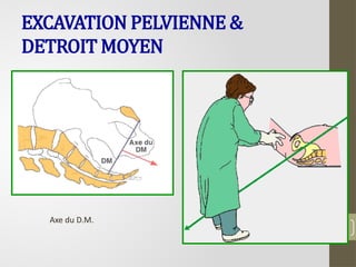 36
EXCAVATION PELVIENNE &
DETROIT MOYEN
Axe du D.M.
 