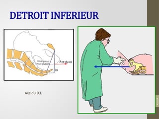 37
DETROIT INFERIEUR
Axe du D.I.
 