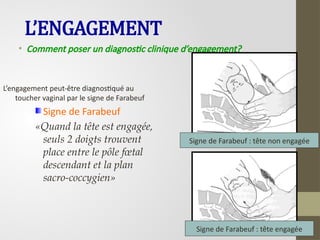 L’ENGAGEMENT
• Comment poser un diagnostic clinique d’engagement?
L’engagement peut-être diagnostiqué au
toucher vaginal par le signe de Farabeuf
Signe de Farabeuf
«Quand la tête est engagée,
seuls 2 doigts trouvent
place entre le pôle fœtal
descendant et la plan
sacro-coccygien»
Signe de Farabeuf : tête non engagée
Signe de Farabeuf : tête engagée
 