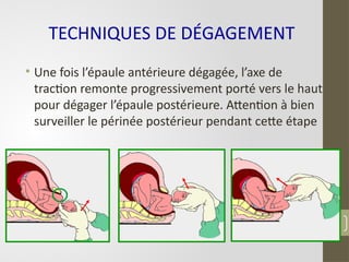 • Une fois l’épaule antérieure dégagée, l’axe de
traction remonte progressivement porté vers le haut
pour dégager l’épaule postérieure. Attention à bien
surveiller le périnée postérieur pendant cette étape
84
TECHNIQUES DE DÉGAGEMENT
 