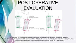 POST-OPERATIVE
EVALUATION
A. Illustrating the measurement deviation calculation at the level of the hex, apex, and angular deviation.
B. B. Represents the measurement deviation calculation of the depth between the virtually planned implant and implant placed
after surgery (aa = apex actual; ap = apex planned, ha = hex actual; hp = hex planned).
 